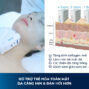 HIFU Làm Tăng Sinh Collagen Như Thế Nào?